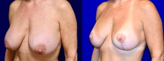 Left 3/4 View - Breast Implant Revision and Breast Lift