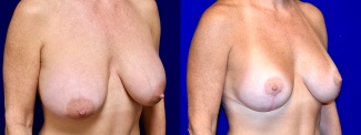 Right 3/4 View - Breast Implant Revision and Breast Lift