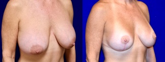 Right 3/4 View - Breast Implant Revision and Breast Lift