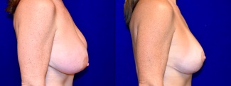 Right Profile View - Breast Implant Revision and Breast Lift