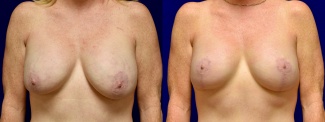 Frontal View - Breast Implant Revision with Galaflex & Breast Lift