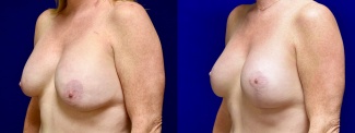 Left 3/4 View - Breast Implant Revision with Galaflex & Breast Lift