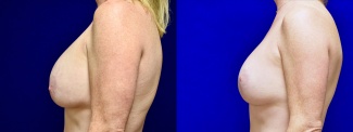 Left Profile View - Breast Implant Revision with Galaflex & Breast Lift