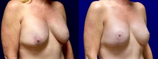 Left 3/4 View - Breast Implant Revision with Galaflex & Breast Lift