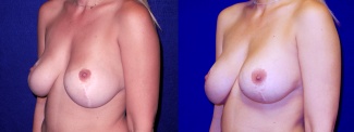 Left 3/4 View - Breast Implant Revision with Galaflex