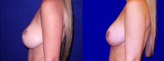 Left Profile View - Breast Implant Revision with Galaflex