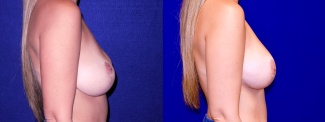 Right Profile View - Breast Implant Revision with Galaflex