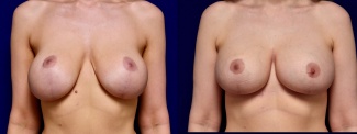 Frontal View - Breast Implant Revision with Galaflex