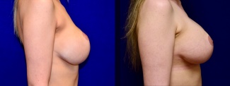 Right Profile View - Breast Implant Revision with Galaflex