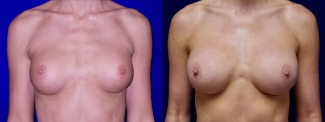 Frontal View - Breast Implant Revision with Galaflex