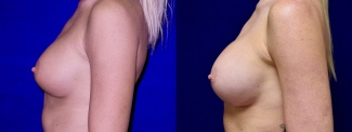 Left Profile View - Breast Implant Revision with Galaflex