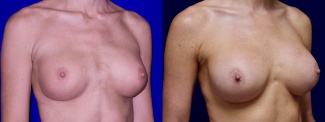 Right 3/4 View - Breast Implant Revision with Galaflex
