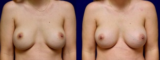 Frontal View - Breast Implant Revision with Galaflex