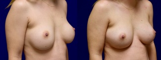 Right 3/4 View - Breast Implant Revision with Galaflex