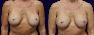 Frontal View - Breast Implant Revision with Galaflex