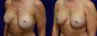 Left 3/4 View - Breast Implant Revision with Galaflex