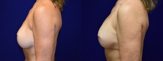 Left Profile View - Breast Implant Revision with Galaflex