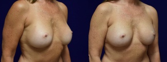 Right 3/4 View - Breast Implant Revision with Galaflex