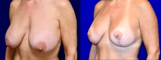 Left 3/4 View - Breast Augmentation Revision with Galaflex