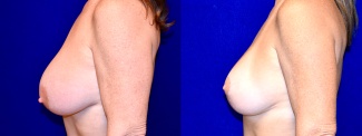 Left Profile View - Breast Augmentation Revision with Galaflex