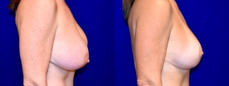 Right Profile View - Breast Augmentation Revision with Galaflex