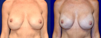 Frontal View - Breast Implant Revision with Galaflex