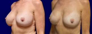 Left 3/4 View - Breast Implant Revision with Galaflex