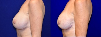 Left Profile View - Breast Implant Revision with Galaflex