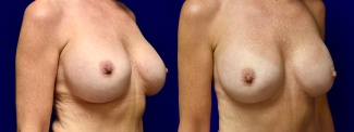 Right 3/4 View - Breast Implant Revision with Galaflex