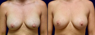 Frontal View - Breast Implant Revision with Galaflex