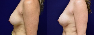 Left Profile View - Breast Implant Revision with Galaflex