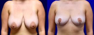 Frontal View - Breast Reduction