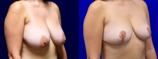 Right 3/4 View - Breast Reduction