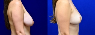 Right Profile View - Breast Reduction