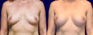 Frontal View - Breast Augmentation