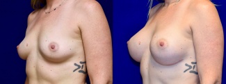 Left 3/4 View - Breast Augmentation