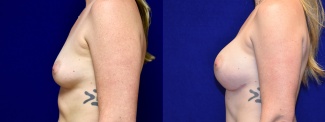 Left Profile View - Breast Augmentation