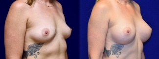 Right 3/4 View - Breast Augmentation