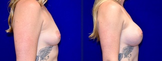 Right Profile View - Breast Augmentation