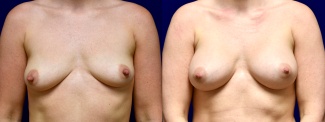 Frontal View - Breast Augmentation with Nipple Reduction