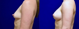 Left Profile View - Breast Augmentation with Nipple Reduction