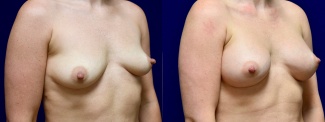 Right 3/4 View - Breast Augmentation with Nipple Reduction