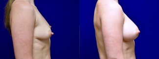 Right Profile View - Breast Augmentation with Nipple Reduction