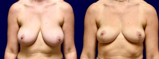 Frontal View - Breast Reduction and Breast Lift with Liposuction