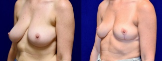 Left 3/4 View - Breast Reduction and Breast Lift with Liposuction