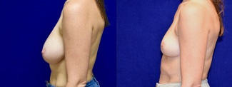 Left Profile View - Breast Reduction and Breast Lift with Liposuction