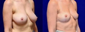 Right 3/4 View - Breast Reduction and Breast Lift with Liposuction
