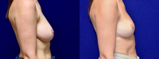 Right Profile View - Breast Reduction and Breast Lift with Liposuction