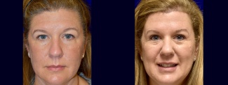 Frontal View - Browlift and Upper Eyelid Surgery