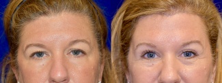 Frontal View - Browlift and Upper Eyelid Surgery